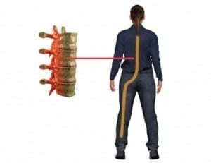 El Paso, TX Sciatica Pain Nerve Treatment