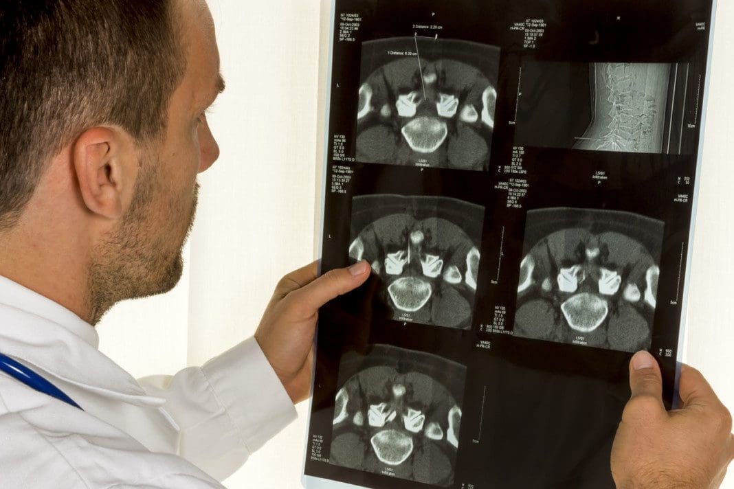Doctor holding MRI scan of spinal disc
