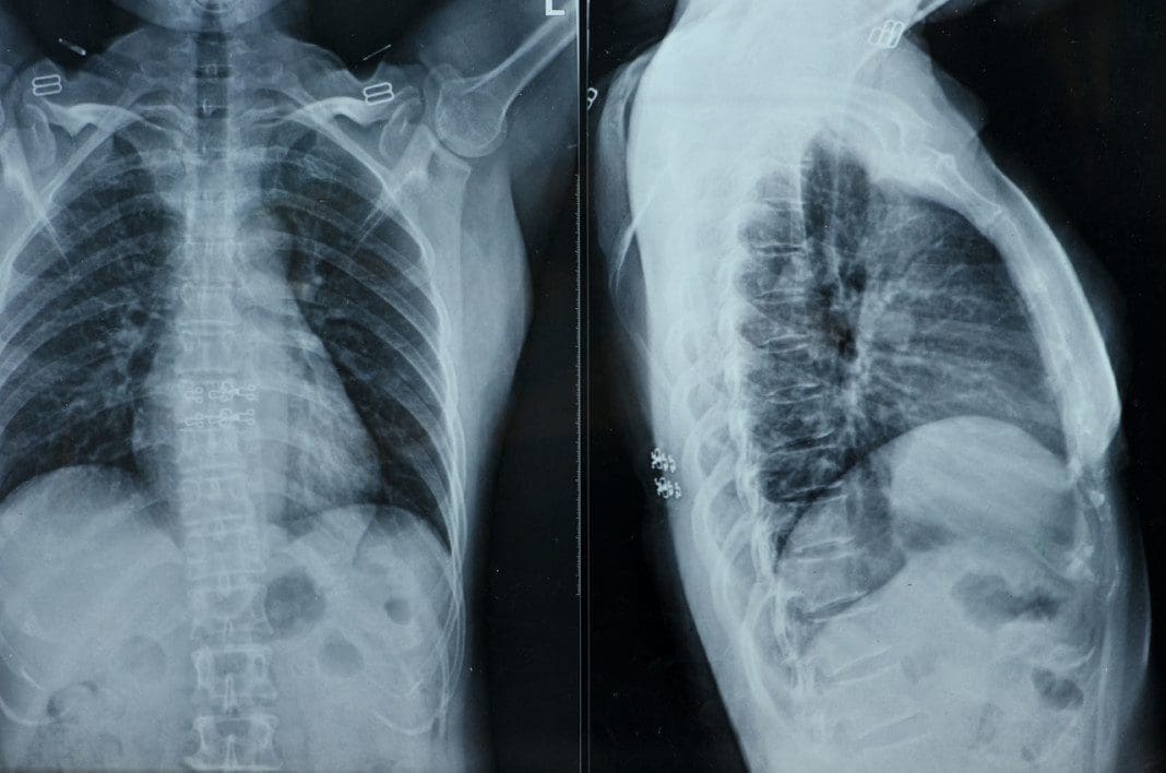 x-rays