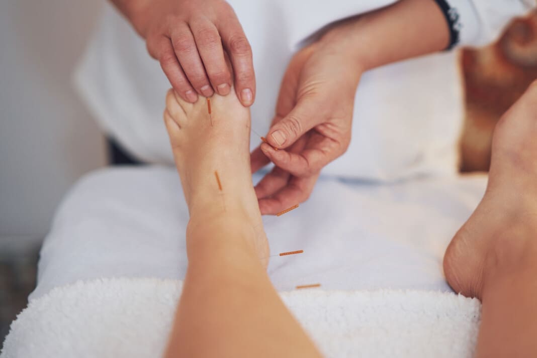 A acupuncture needle therapy in the studio