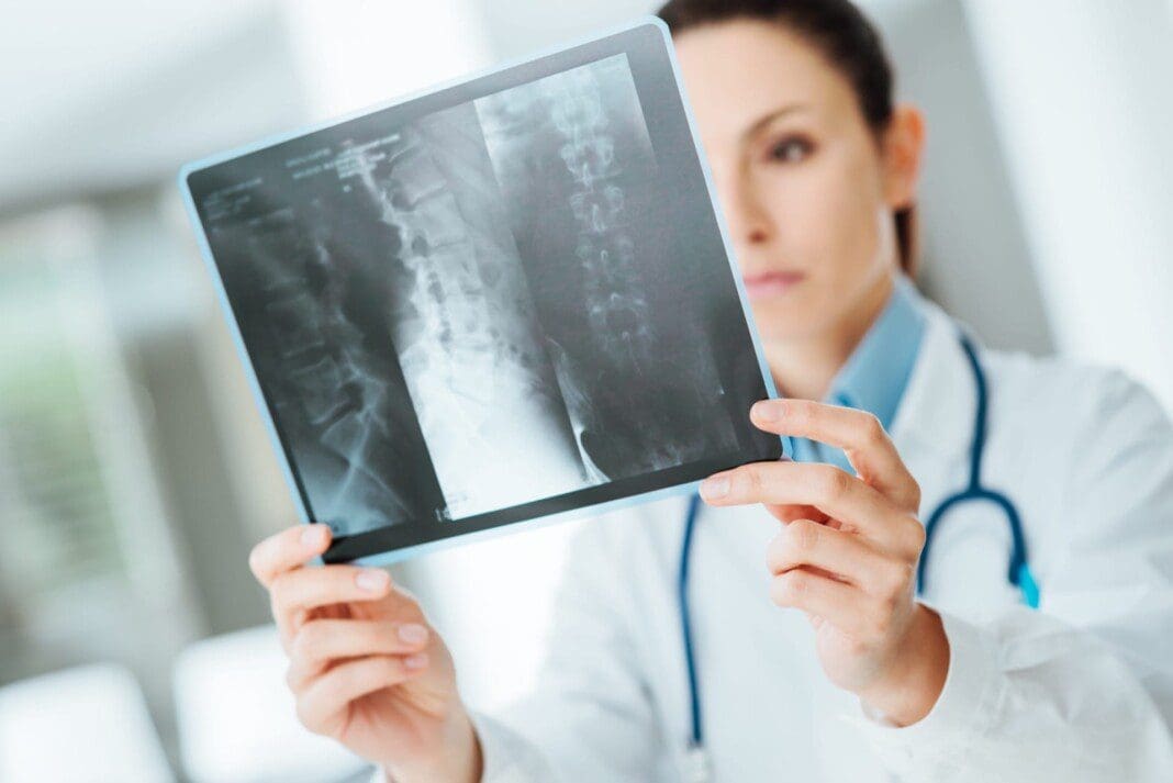 spine-fracture-decompression