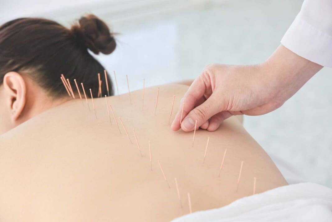 woman-laying-on-table-receiving-acupuncture-along-spine