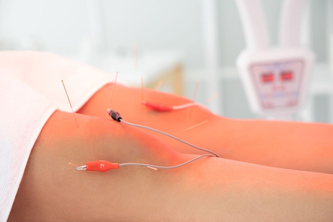 Electro+acupuncture-muscle