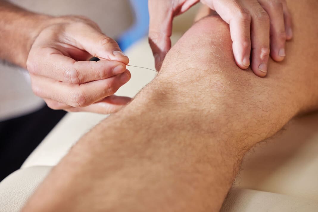 Acupuncture has done wonders for my knee. Shot of a acupuncturis
