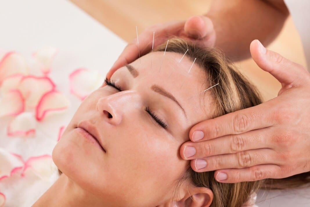 acupuncture-headaches