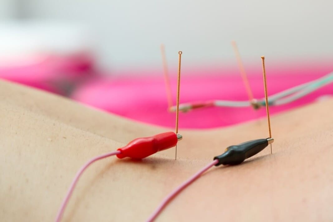 electro-acupuncture-chiropractic-treatment-toronto