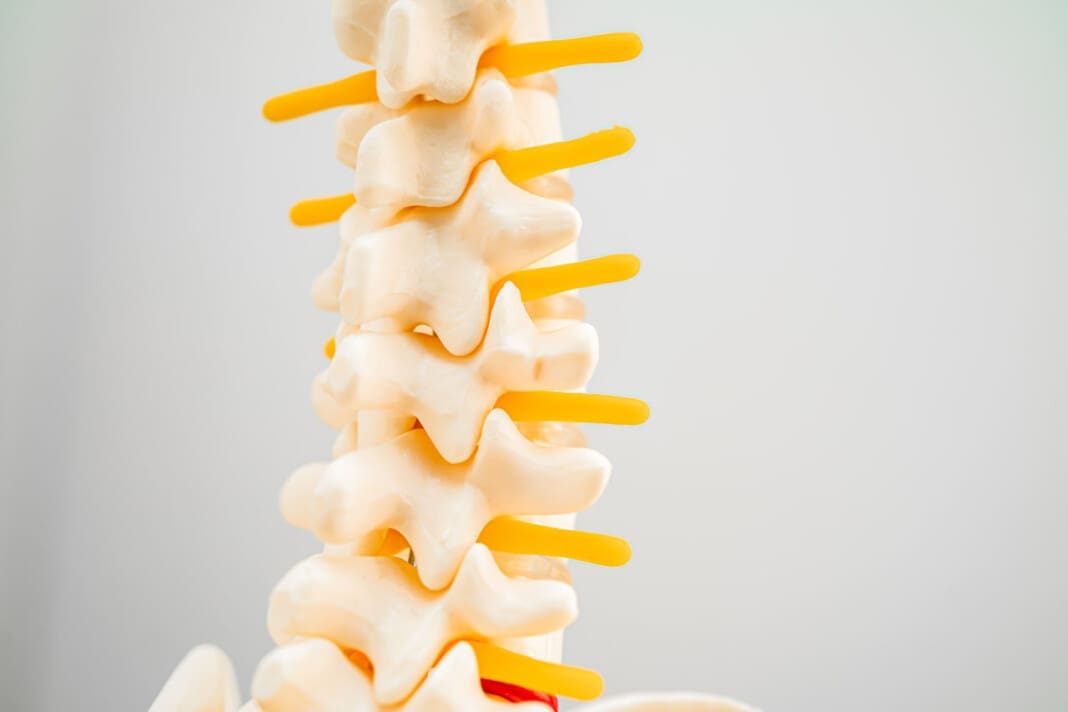 Lumbar spine displaced herniated disc fragment, spinal nerve and