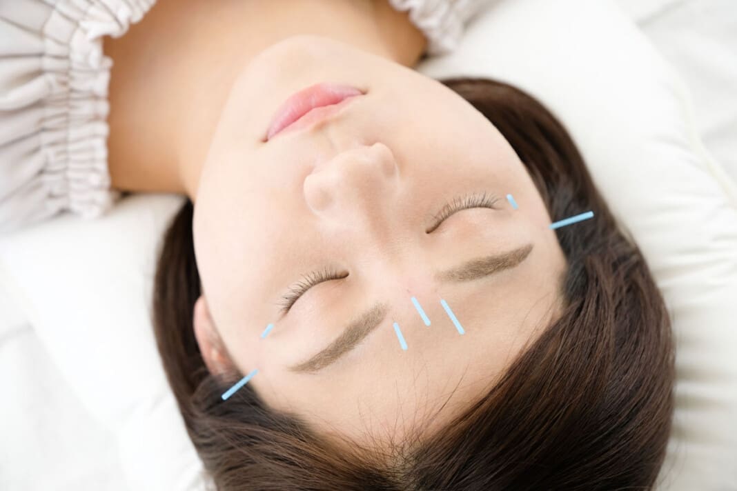 Up of a woman getting acupuncture on her face at an acupuncture